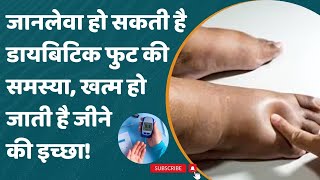 Diabetic Foot अक्सर बढ़ा रहता है Sugar Level कहीं कटाना न पड़ जाए पैर [upl. by Sabsay]