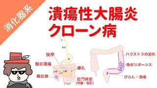 【国試対策用】潰瘍性大腸炎とクローン病 [upl. by Eliga]