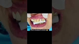 dentistry endodontist endodoncia conservative dentist post fixedcrownrestoration [upl. by Arelus831]