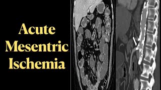 Acute Mesenteric Ischemia AMI [upl. by Htebazie236]