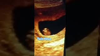 Ultrasound of fetal well being Twin CRL Monochronic amp Monoamnotic youtubeshorts shorts pregnacy [upl. by Pellegrini274]