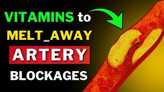 Remove Artery Plaque Naturally 6 Powerful Vitamins [upl. by Markus309]