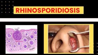 Rhinosporidiosis Subcutaneous Mycosis [upl. by Nhguavad]