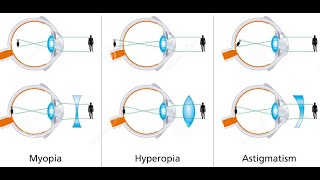 EYE DEFECTS amp THEIR correction  grade 12 life sciences  ThunderEDUC  MSAIDI [upl. by Sualk]