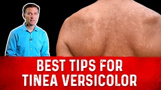 Best Tips for Tinea Versicolor Treatment Skin Fungus – Dr Berg [upl. by Ardnuassak]