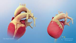 Normal Heart Anatomy vs Hypoplastic Left Heart Syndrome HLHS Anatomy [upl. by Ynahpit]