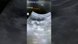 Renal Calculi ultrasound shortvideo shorts [upl. by Alahc858]