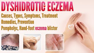 Dyshidrotic Eczema Causes Types Symptoms Treatment Remedies and Prevention  Pompholyx eczema [upl. by Jarrod369]