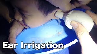 5 Year Old Boys Earwax Removal by Ear Irrigation [upl. by Tenenbaum585]