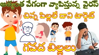 చెంప గడ్డలు  గవద బిల్లలు  Mumps in telugu  How To Cure Mumps At home  RmpdoctorteluguMumps [upl. by Philana]