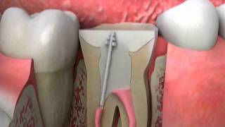 Crowns Post and Core Procedure [upl. by Al]