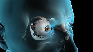 Glaucoma Surgery [upl. by Burrus]