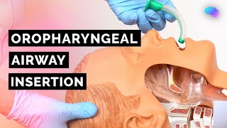 Oropharyngeal Airway Insertion  Guedel  OPA  ABCDE Emergency  OSCE Guide  UKMLA  CPSA [upl. by Kassie]