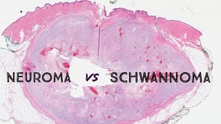 Neuroma vs Schwannoma palisaded encapsulated neuroma nerve sheath tumor dermpath dermatology [upl. by Yanal]