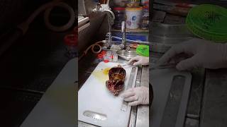 ovarian cyst cyst histopathology [upl. by Lebatsirc622]