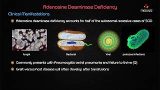 Adenosine deaminase ADA deficiency [upl. by Carnes632]