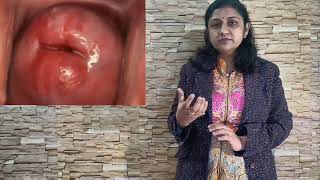 Nabothian cyst सर्विक्स बच्चेदानी के मुंह पर घाव का इलाजक्या सफेद पानी [upl. by Anisamot290]