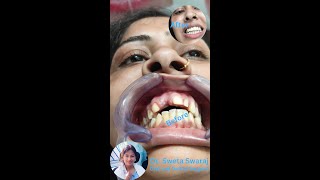 Female Teeth Capping Damage teeth repair teethcapping crown teeth teethcare dentaltreatment [upl. by Quincy741]