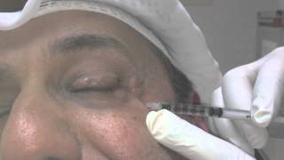 Blepharospasm and Botox Treatment [upl. by Aivul336]