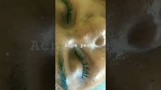 Acne peel [upl. by Balbinder317]