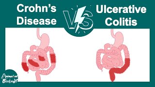 Crohns disease vs Ulcerative colitis  Pathology  USMLE step 1 [upl. by Thielen]