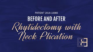 Rhytidectomy Full Facelift Patient 201810000 Before amp After [upl. by Geraud]