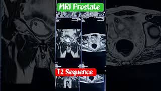 MRI prostate mri ctscan [upl. by Germaun289]