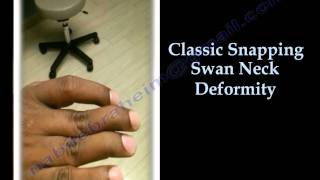 Swan Neck Deformity Classic Snapping  Everything You Need To Know  Dr Nabil Ebraheim [upl. by Terag]