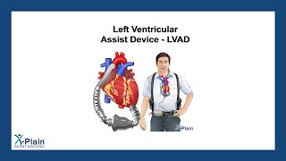 Left Ventricular Assist Device  LVAD [upl. by Ahsiym]