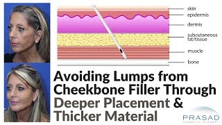 How Lumps from Cheek Filler Placement can be Avoided with Deeper Placement and Thicker Filler [upl. by Semmes]