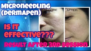 RESULT OF DERMAPEN Microneedling is it effective “Tagalog” [upl. by Aloise]