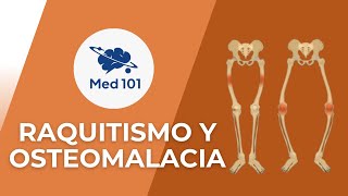 Raquitismo y osteomalacia 101 [upl. by Rissa]