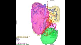 Liver Analysis by Synapse 3D [upl. by Acebber]