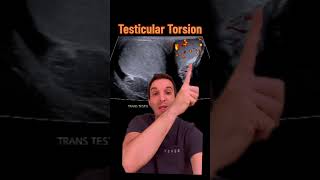 Diagnosing testicular torsion on ultrasound [upl. by Rosetta]