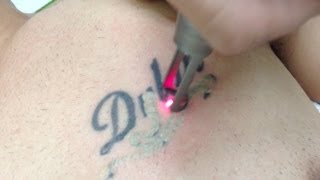 Tattoo Removal using Spectra Laser  Los Angeles Skin Perfect Brothers [upl. by Manus]