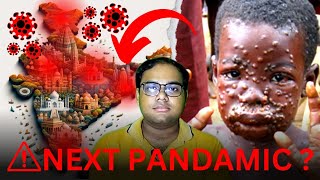 NEXT PANDAMIC Monkey Pox Signs amp Symptoms monkeypox mpox reetmukherjee [upl. by Hguh]