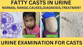 FATTY CAST IN URINECAUSES SYMPTOMS TREATMENT OF FATTY CASTS IN URINE EXAMINATION IN HINDI [upl. by Hudson809]