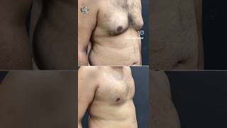 Vaser Liposuction  Liposuction plastic Surgeon  Body Contouring by Dr Amin Yousaf [upl. by Wernsman]