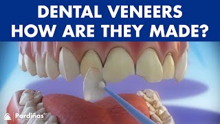 Veneers  How are they made Preparation and placement of cosmetic dentistry veneers © [upl. by Hurlow634]