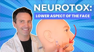 Neurotoxins Lower Aspect of the Face [upl. by Nollie]