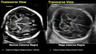 Edwards Syndrome Trisomy 18 Antenatal Ultrasound Features  Fetal USG Normal Vs Abnormal Images [upl. by Aytnahs]