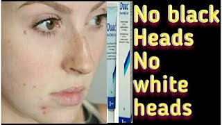 Best jel for acnecyst scars whiteheads and blackheads [upl. by Bryner]