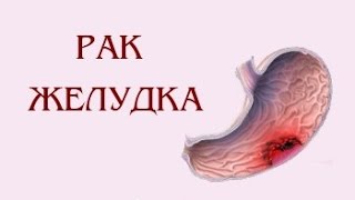 Современные способы лечения рака желудка на разных стадиях [upl. by Grimaldi624]