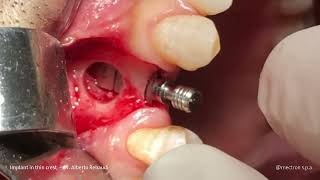 IMPLANTOLOGY  REX  Dr Alberto Rebaudi  Implant in thin crest [upl. by Kironde431]