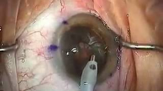 Modern Cataract Surgery Alcon ReSTOR IOL with LRI [upl. by Velleman]