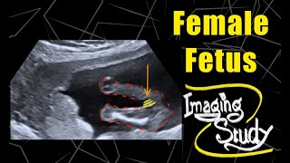 Female Fetus  16 weeks  Ultrasound  Case 81 [upl. by Artus]