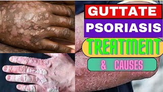 How to cure GUTTATE PSORIASIS CAUSES OF PSORIASIS TREATMENT PHOTOTHERAPY DERMATOLOGY AUTOIMMUNE [upl. by Ailuig686]