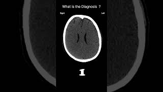 Hypoxic brain injury with cerebral oedema Acute CT Brain Brain volume 57 radiologychannel007 [upl. by Roleat]