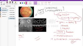 Hypotonous maculopathy [upl. by Alanna]