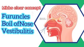 Furuncles  Boil of Nose  Vestibulitis  Disease of nasal vestibules [upl. by Niletak]